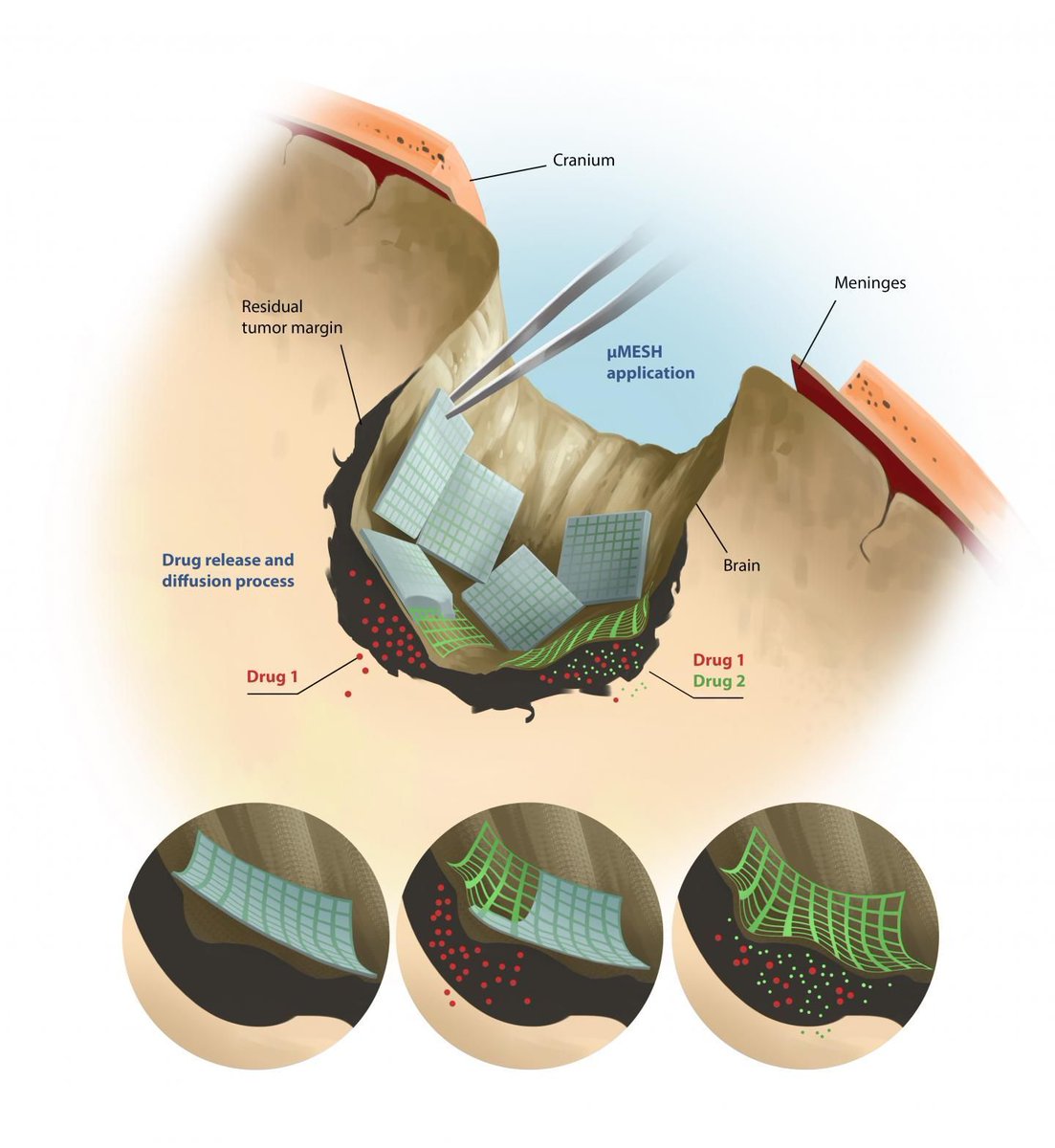 talius's tweet photo. #MicroMESH: A #Microscopic #Polymeric Network to attack #Glioblastoma multiforme
A micro-sized polymeric net wrapping around brain tumors, a new #nanomedicine device capable of conforming around the surface of tumor masses and efficiently delivering drugs https://t.co/RvBxCi6eJ6 https://t.co/5o6Zd1cDcE