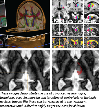 UMmedschool's tweet image. #UMSOM seeks patients for clinical trial of focused ultrasound for #trigeminal #neuralgia

fusfoundation.org/news/clinical-…