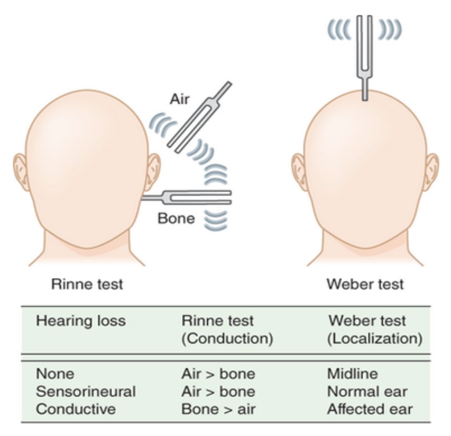 12. This implies right sensorineural deafness. In Weber’s test if there is a sensorineural deafness then the sound localises to the unaffected side. Here is a useful schematic demonstrating this well..