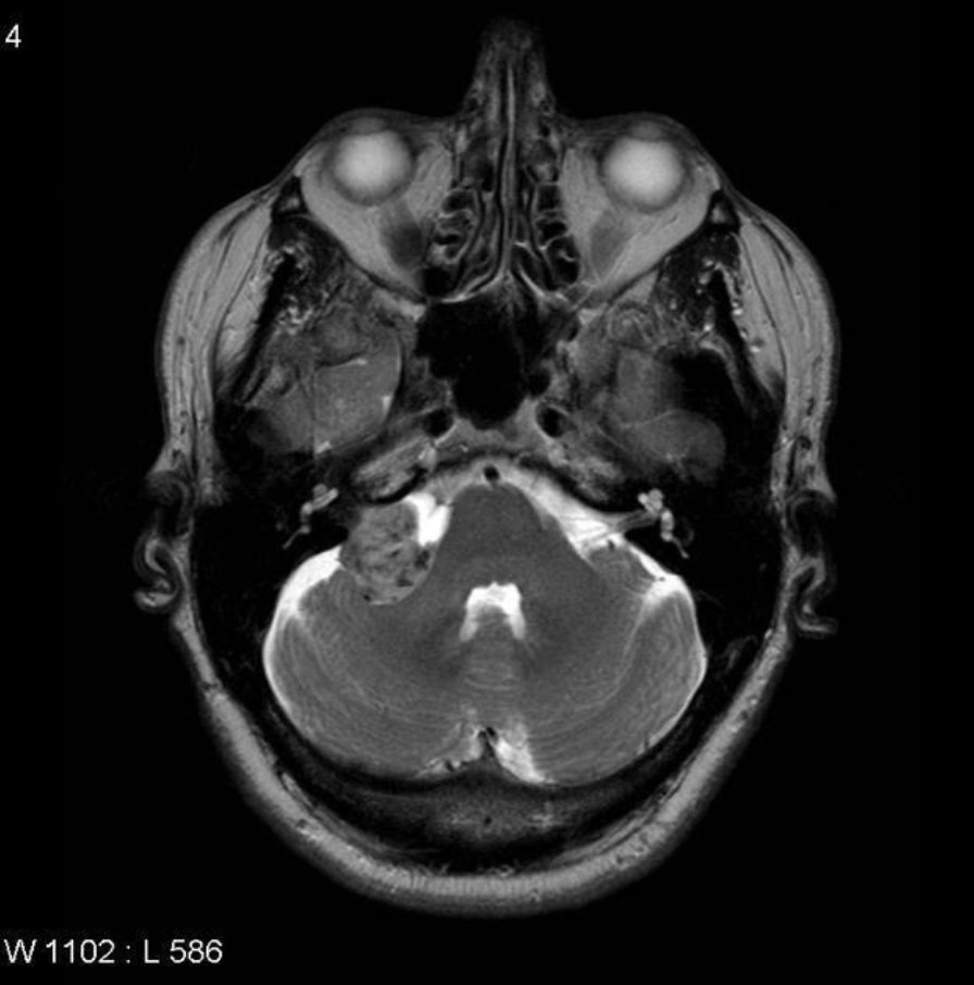17. An MRI head with and without contrast is performed. MRI scans have become the gold standard imaging test and are especially useful for detecting soft tissue masses. Below is the result of the MRI head, what do you see?