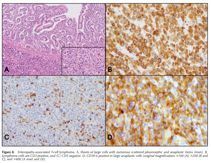 ArchivesPath's tweet photo. "Gastrointestinal Tract Lymphomas: A Review of the Most Commonly Encountered Lymphomas" Alvarez-Lesmes et al. #EarlyOnline #gipath #hemepath https://t.co/aEeDw0SPfi https://t.co/rvs7UdkIyi
