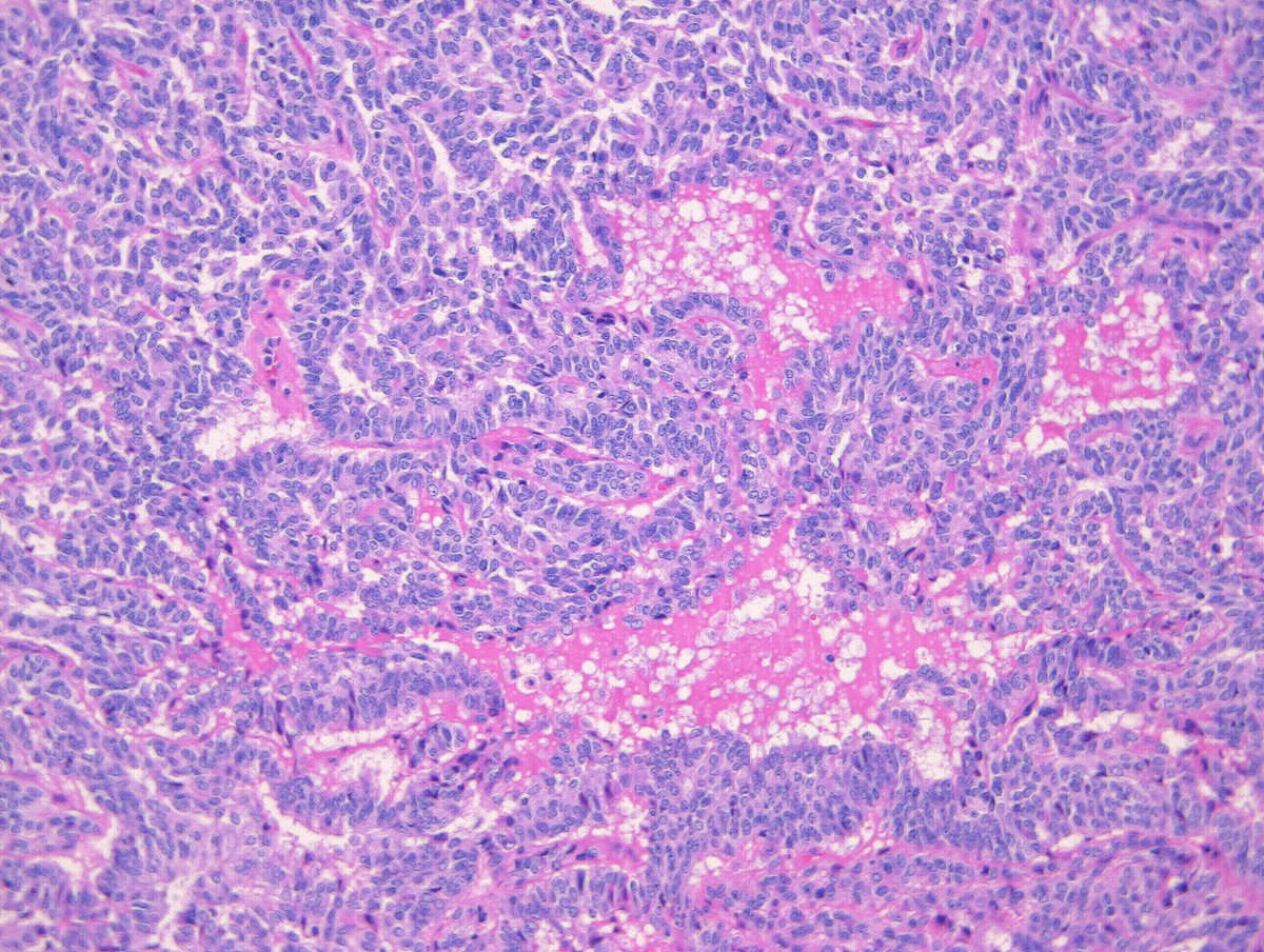 12 year old girl with "cystic ovarian mass" per surgeon. #gynpath