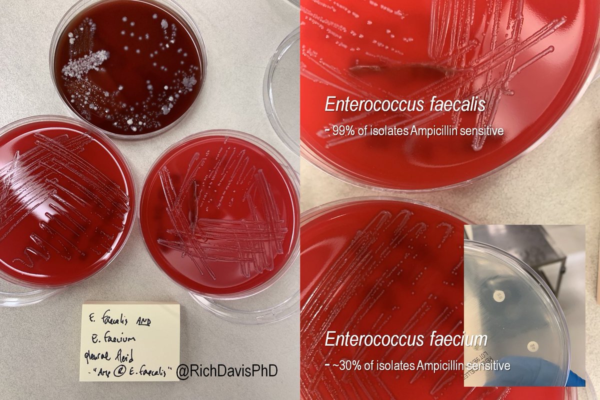 richdavisphd's tweet image. #MicroRounds (Day 847): for #LabWeek2021 #WhyClinMicroMatters and why techs matter!

Pleural fluid w/ mixed bugs. Enterococcus faecalis (~99% isolates Ampicillin S) was Amp R. Huh?

Tech knew something was off, went looking: mixed w/ resistant E. faecium! #ASMClinMicro #IDTwitter