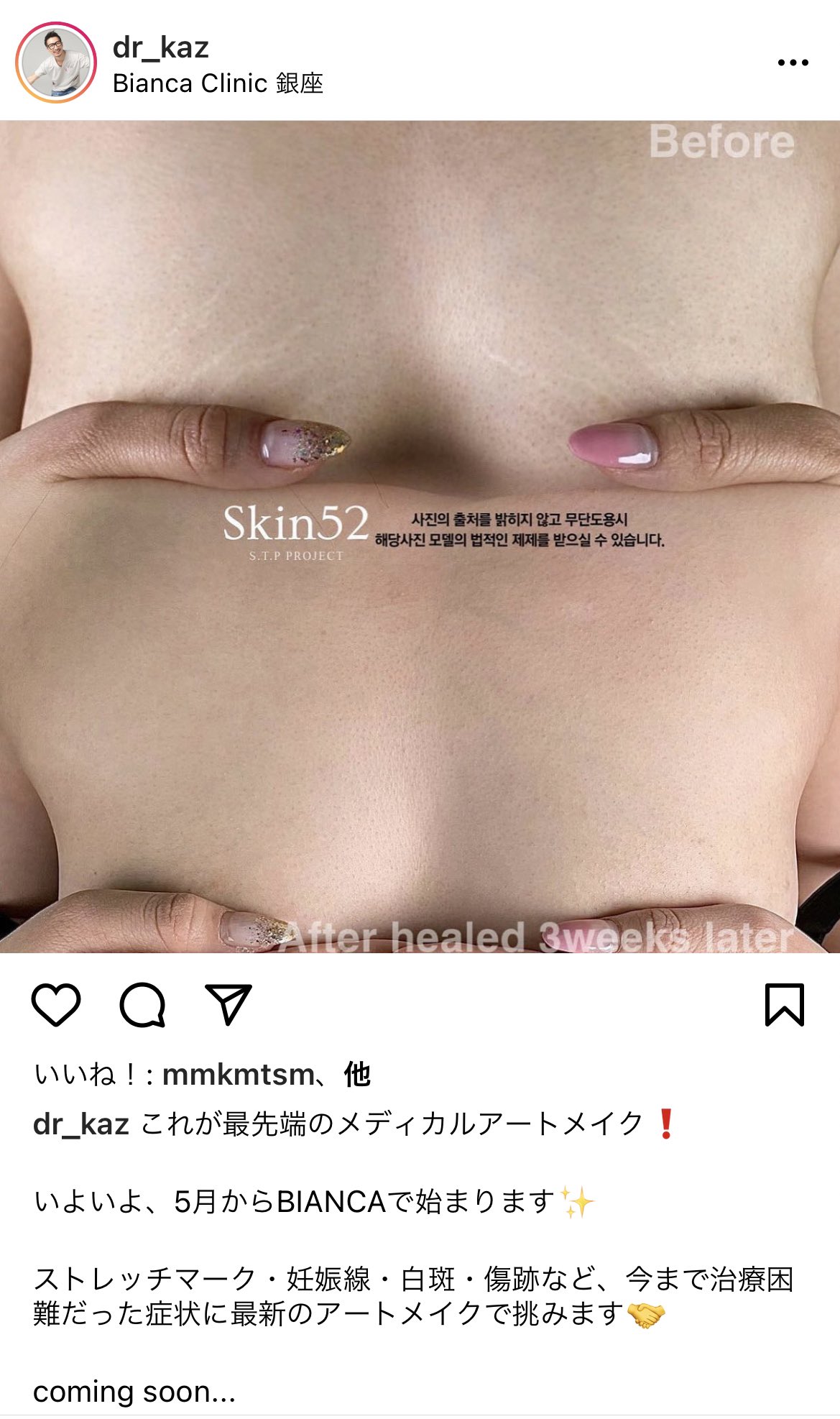 にゃむこ 争う前に渡韓させろ No War ビアンカのカズ先生のインスタに載ってたんだけど 妊娠線や肉割れをアートメイクで消す方法 ほんとにこんなに綺麗に消えるなら凄いね 範囲広いからめっちゃ高そうだけど 笑 T Co Lgourhylyi Twitter