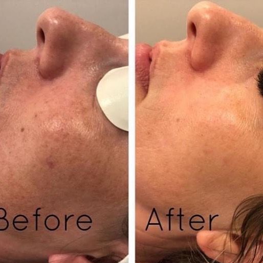 RubyChe15710149's tweet image. IPL
 Our #IPL comes with two/three hand pieces with different wavelengths:
Skin rejuvenation Acne,Pigmentation 
Super hair removal, different modes treatment areas
Vascular, redness, rosacea treatment
5+ phenomental treatments wrapped into one system #FDA, #TGA approved!