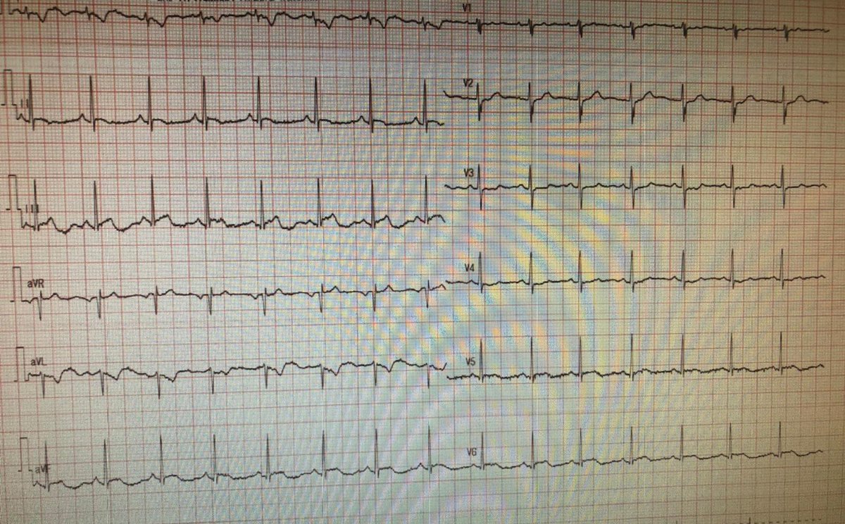 On bilante. C’est pas évident pour tout le monde mais c’est pas parce qu’on a 18 ans qu’on ne peut pas être malade du coeur. Le contexte est suspect de covid. Les grandes complications connues cardio sont embolie pulmonaire, myocardite, SCA. Le strict minimum c’est un ECG 