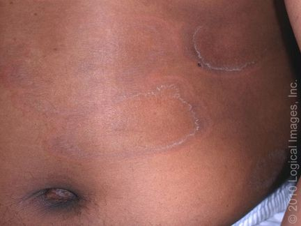 Great work with yesterday's Rash of the Day! A new one for today - what is your diagnosis? (I've included pictures of both darker and lighter skin tone, but both are the same diagnosis) #dermtwitter #medtwitter #RashOTD pc: @dermnetnz @VisualDx