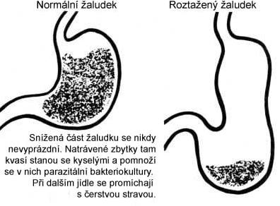 PohybT's tweet image. NENÍ zvracení, jako zvracení! Vamana Dhautí je zvracení cílené a chtěné. 
🍁 Důvod k výplachu žaludku je jeho anatomická deformace, při neustálém namáhání velkým množstvím potravy. Jde o jeho prověšení spodní části.😱
🍁 V této vzniklé kapse dochází k namnožení patogenních kultur