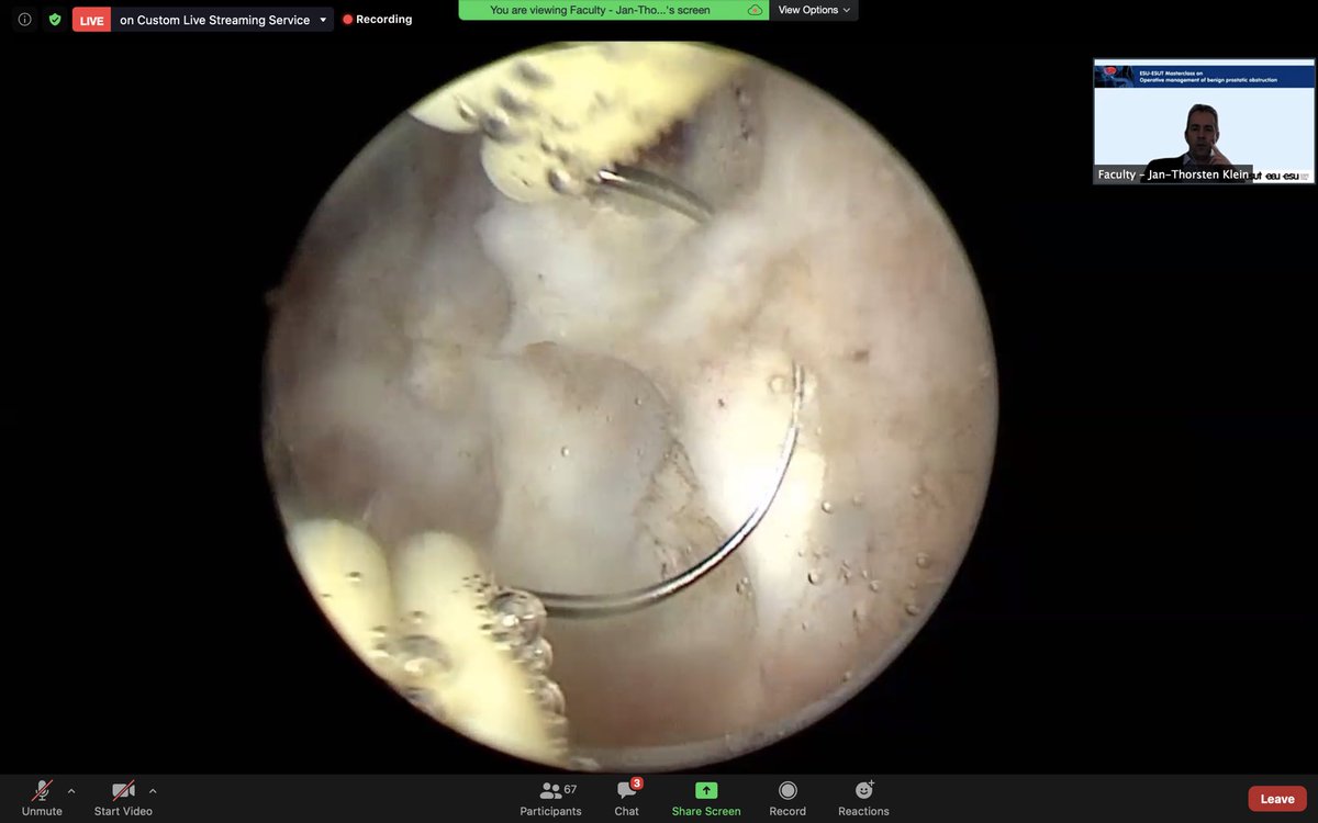 Virtual Masterclass in operative management of benign prostate obstruction It’s was very interesting #esubpo21