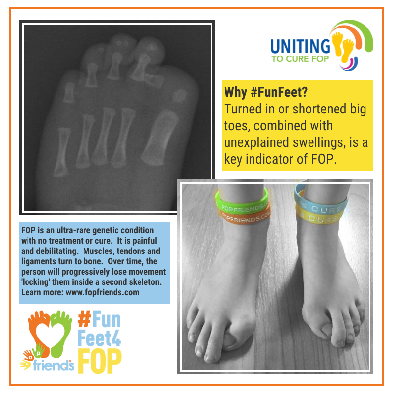 FOPFriends's tweet photo. Today we are raising awareness of FOP by sharing our #FunFeet4FOP... Why feet? Because turned in or shortened big toes, combined with unexplained swellings, is a key indicator of FOP. So show us your toes.... #CureFOP #GlobalFOPAwarenessDay #FOPFriends https://t.co/g69tWDHPQu