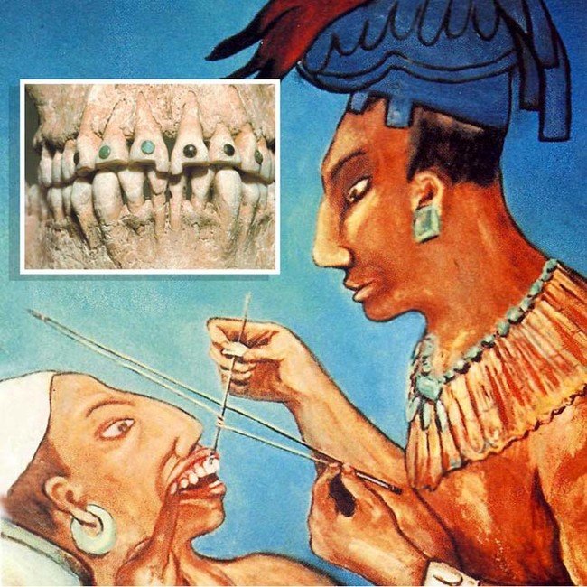 EngleDentistry's tweet photo. FUN FACT FRIDAY

The Mayans used to take seashells, whittle them down to the shape of a tooth and hammer them in along with some jewels for style. OUCH!!!!

Good thing we do things a little differently here Engle Dentistry ! https://t.co/FcoTPnQYeZ