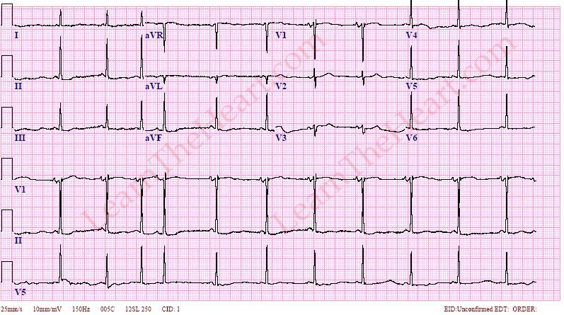 Укороченный интервал pq синдром clc. Clc синдром экг. Слабость синусового узла на экг. Синдром бругада на экг 1 типа. Кардиограмма синдромов.