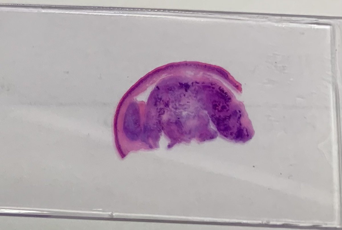   #bstpath I know it is Friday. But I do have this case for your opinion . It is an index finger amputation with a 2.5 cm mass. There are quite some giant cells. I intend to call it giant cell tumor of tendon sheath, but the prominent chondroid changes are the first time for me.1/