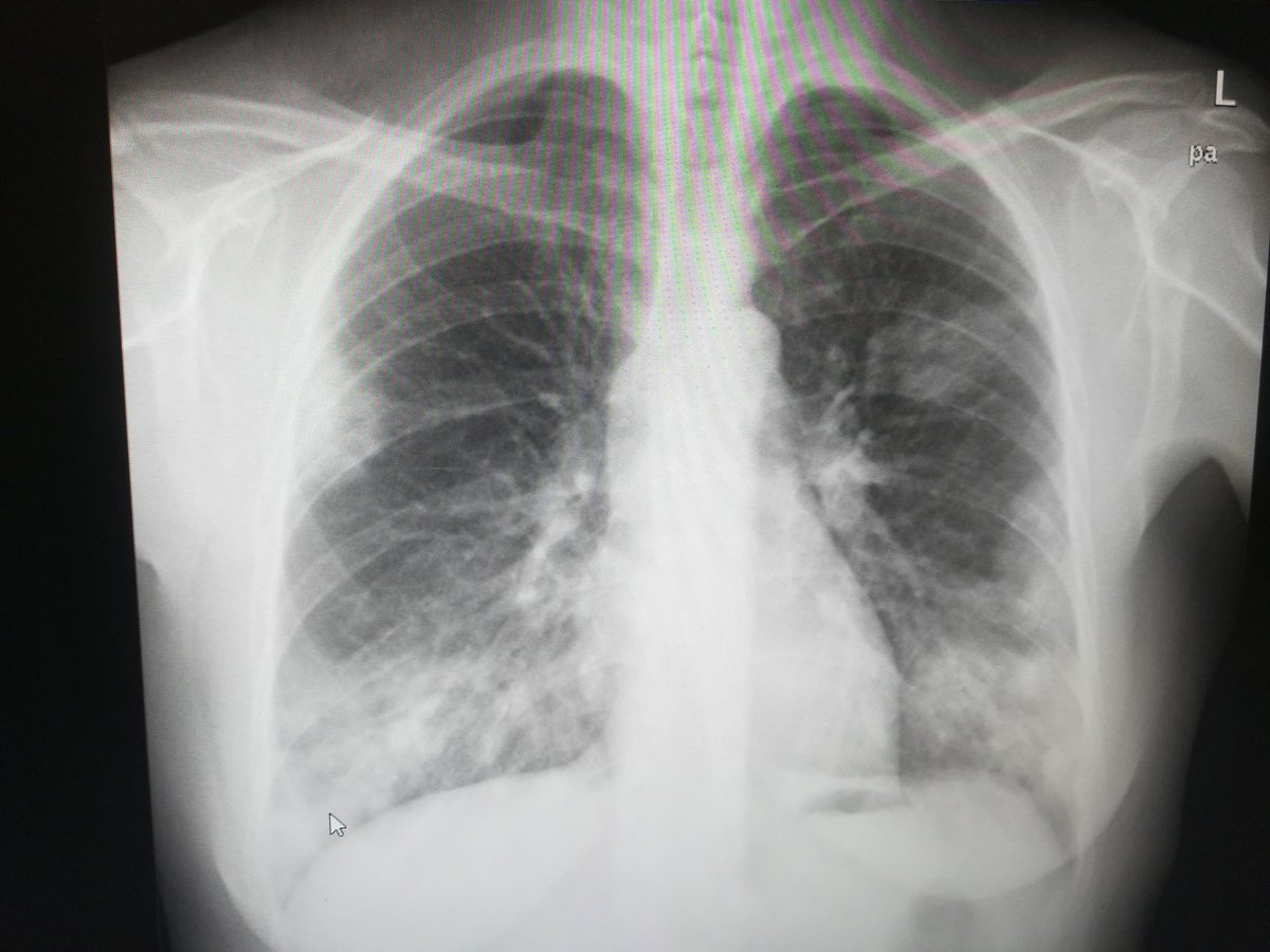 ccarballo50's tweet photo. Desde las trincheras: mal día de COVID hoy, muuuuucha gente, gente joven y malos. Placa con neumonia bilateral extensa en chica joven de 40 años...no vacunada claro.. Aún queda guerra... Cuídense y vacunense. https://t.co/zaDVr22RPJ