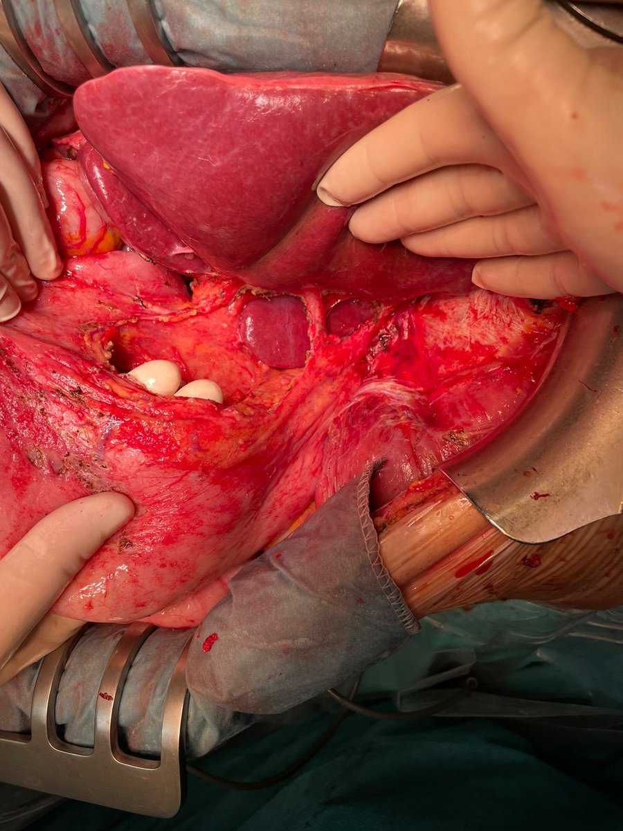 Keep going: left diagram, omentectomy, splenectomy and lesser omentectomy done