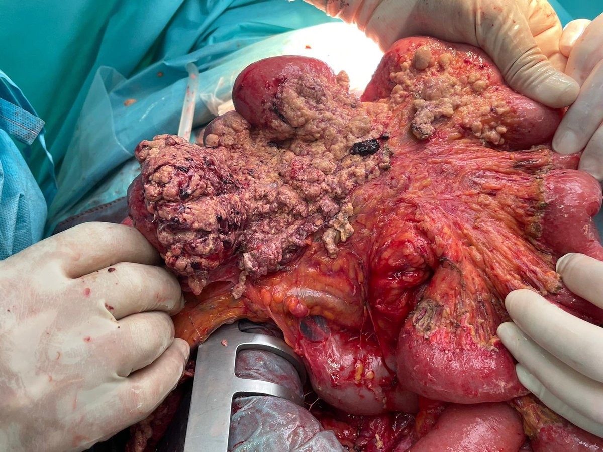 Tedious work... but can be done. Compare and contrast cleaned up section with non- done section ( final 40cm of ileum that will be resected with R colectomy)