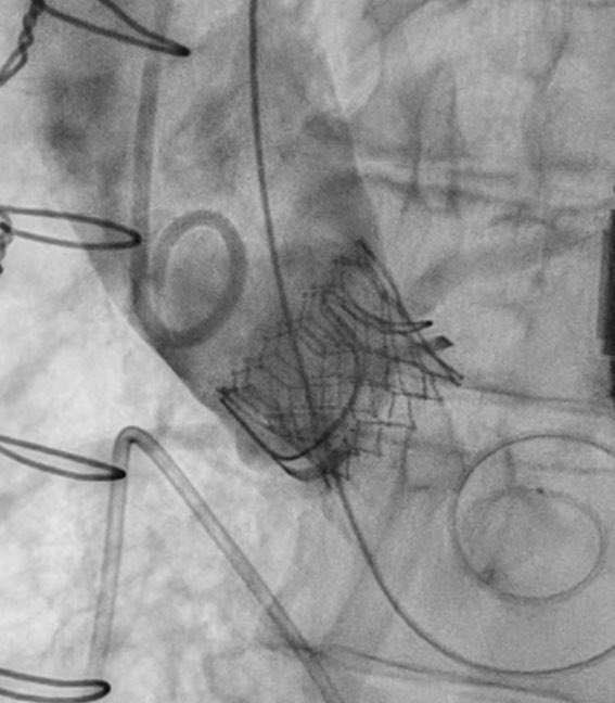 After couple trace residual MR #MitraClip cases, double laceration to end the afternoon @VinodThourani @vrajagopalMD #TAVR #TMVr #REPAIRMR