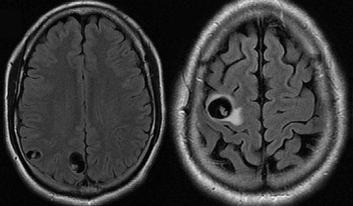 #IDtwitter, #MedEd, #FOAMed, I have a #TropMed case for you...

A 38-year-old man from South America presented with seizures. His MRI is shown below⬇️, and the enzyme-linked immunotransfer blot (EITB) for cysticercosis is positive.

How would you treat this patient?
