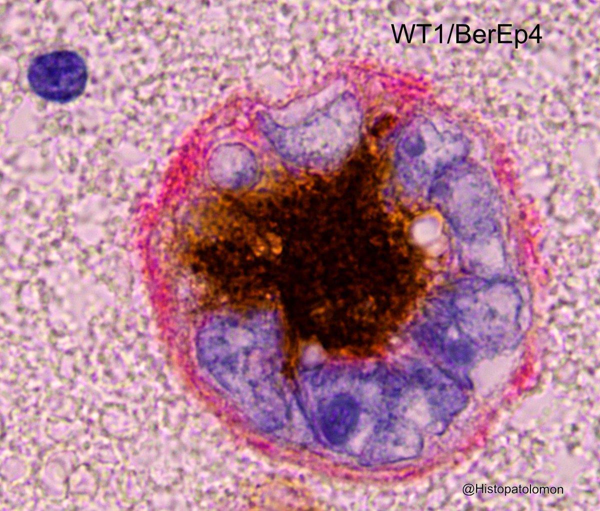 Histopatolomon's tweet photo. Another giant cell, where the distribution of the staining is clearly seen. WT1 (brown) central, BerEp4 (red) peripheral. Cell block.
#WT1 #BerEp4 #IHCpath #adenocarcinoma #pulmon #citologia #cytopath #cytology #pathology #lungcancer #cellblockcytology https://t.co/u6OVOTcSHo