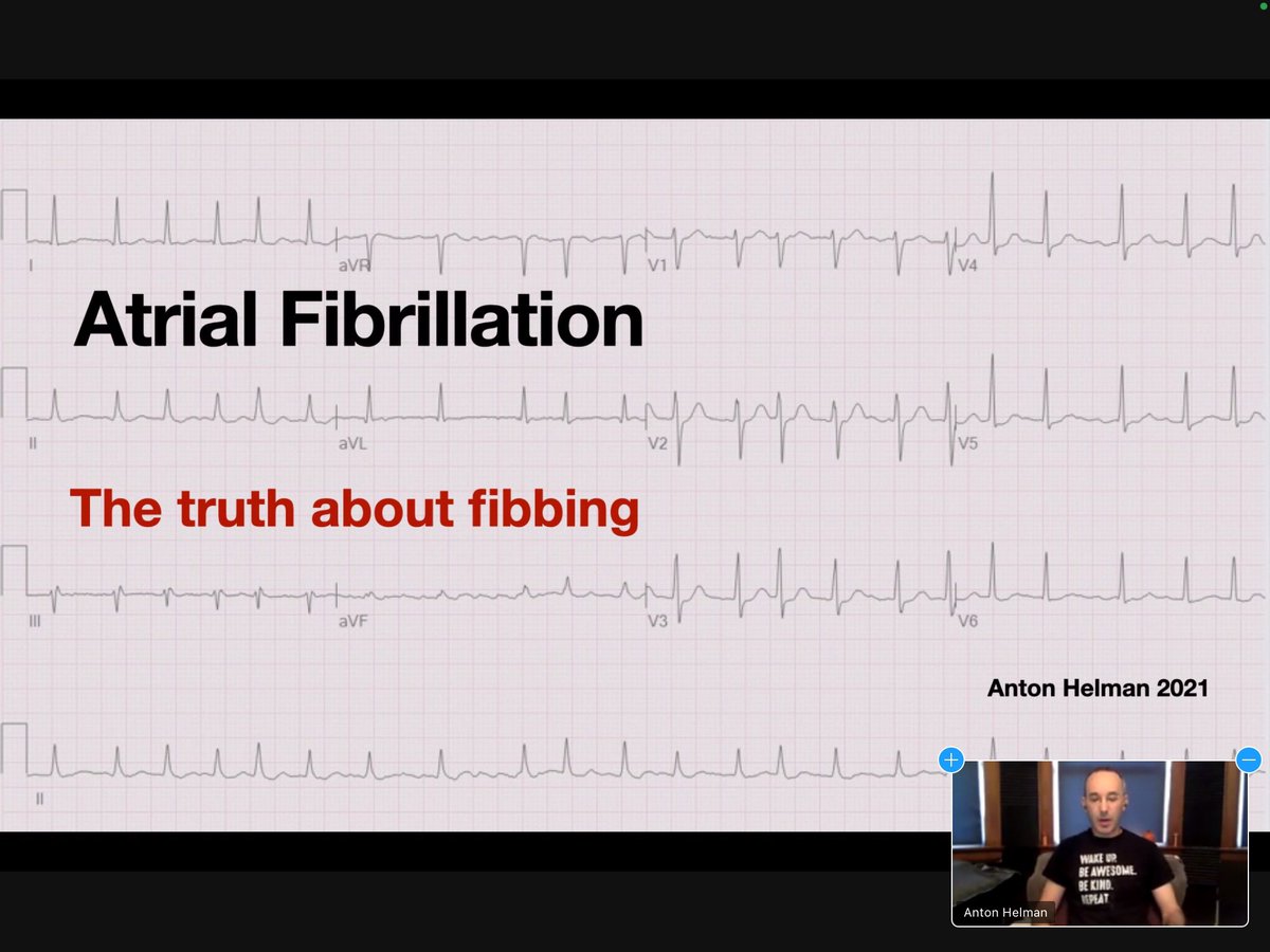 Great lecture by Anton Helman yesterday on Atrial Fibrillation. #Cardiology #UKZNEmergencyMedicine