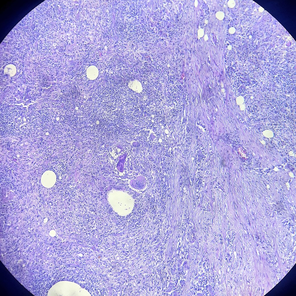 drsofa's tweet photo. Need some expiriences from colleagues.
Right breast tumor, ● 8 cm. female 25 years old.
Thank you 🙏

Lots of lymphocyt and giant cell. 
Hobnail and intraductal papillary structure.
@PoloniaAntonio @DrRolaAli @breastpath #breatpath #pathology https://t.co/jSRxaqH1MW