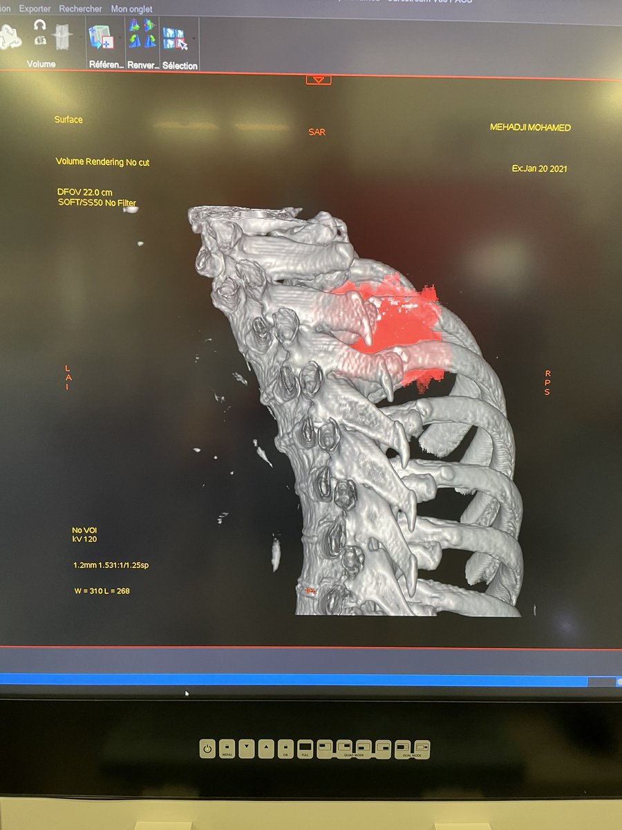 Robotic surgery for complex RUL with rib involvement/2 stages surgery  <a href="/CHURouen/">CHU de Rouen</a> <a href="/MTC_Rouen/">MTC Rouen</a>