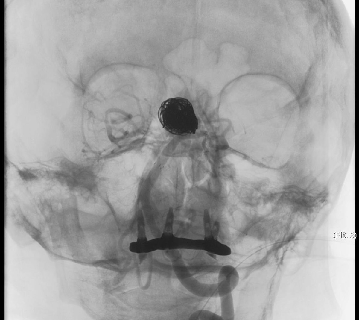 New tools, more experience, very difficult aneurysms became possible to treat with acceptable risks. Y stenting, coil embolization, and of course, #RadialFirst