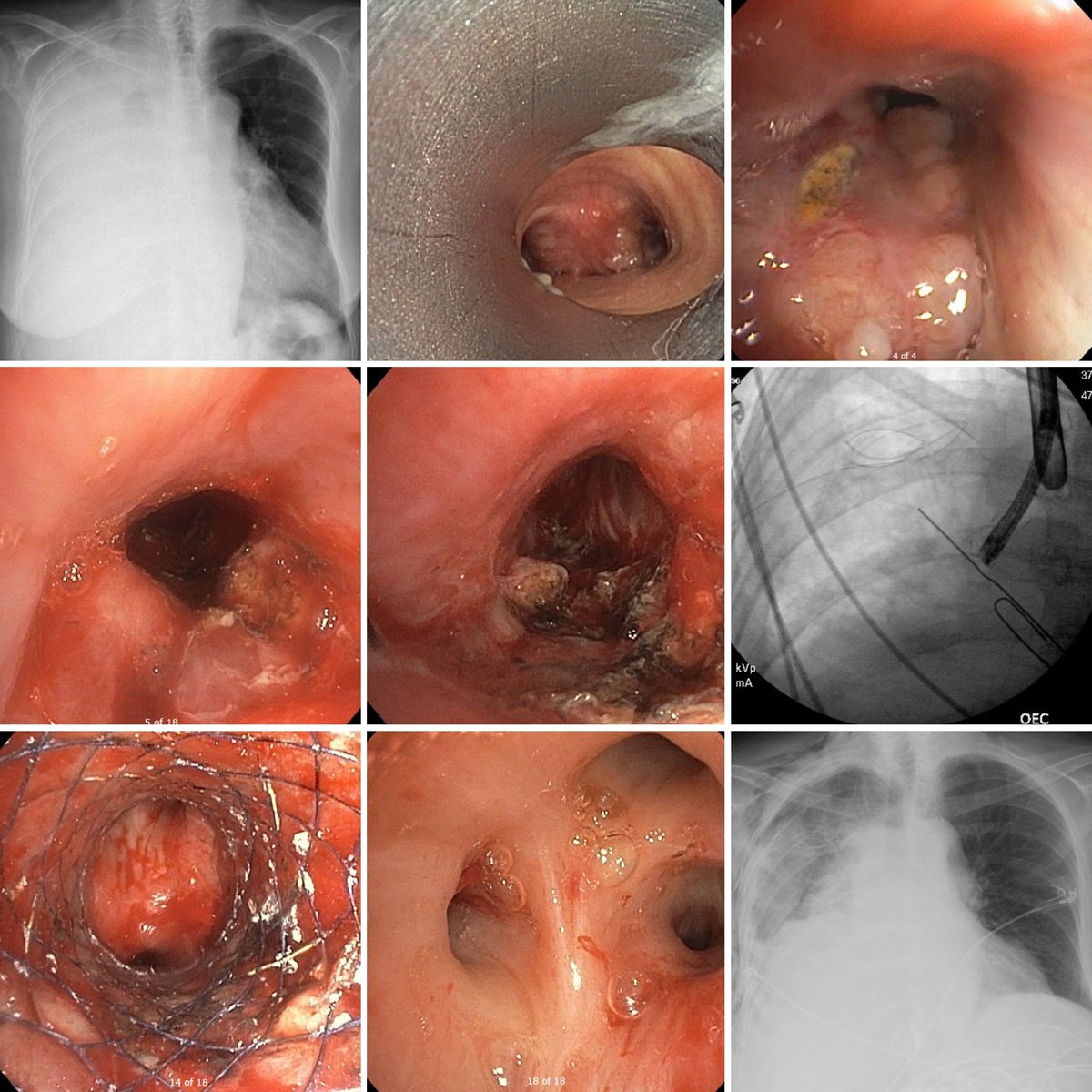 One stop shop. Combining multiple interventions to address complex lung cancer related problems. Debulking and stenting of right main bronchial tumor together with placement of tunneled pleural catheter to improve right lung aeration and functional status. With <a href="/pulmo_dok/">Napoleon Puente</a>