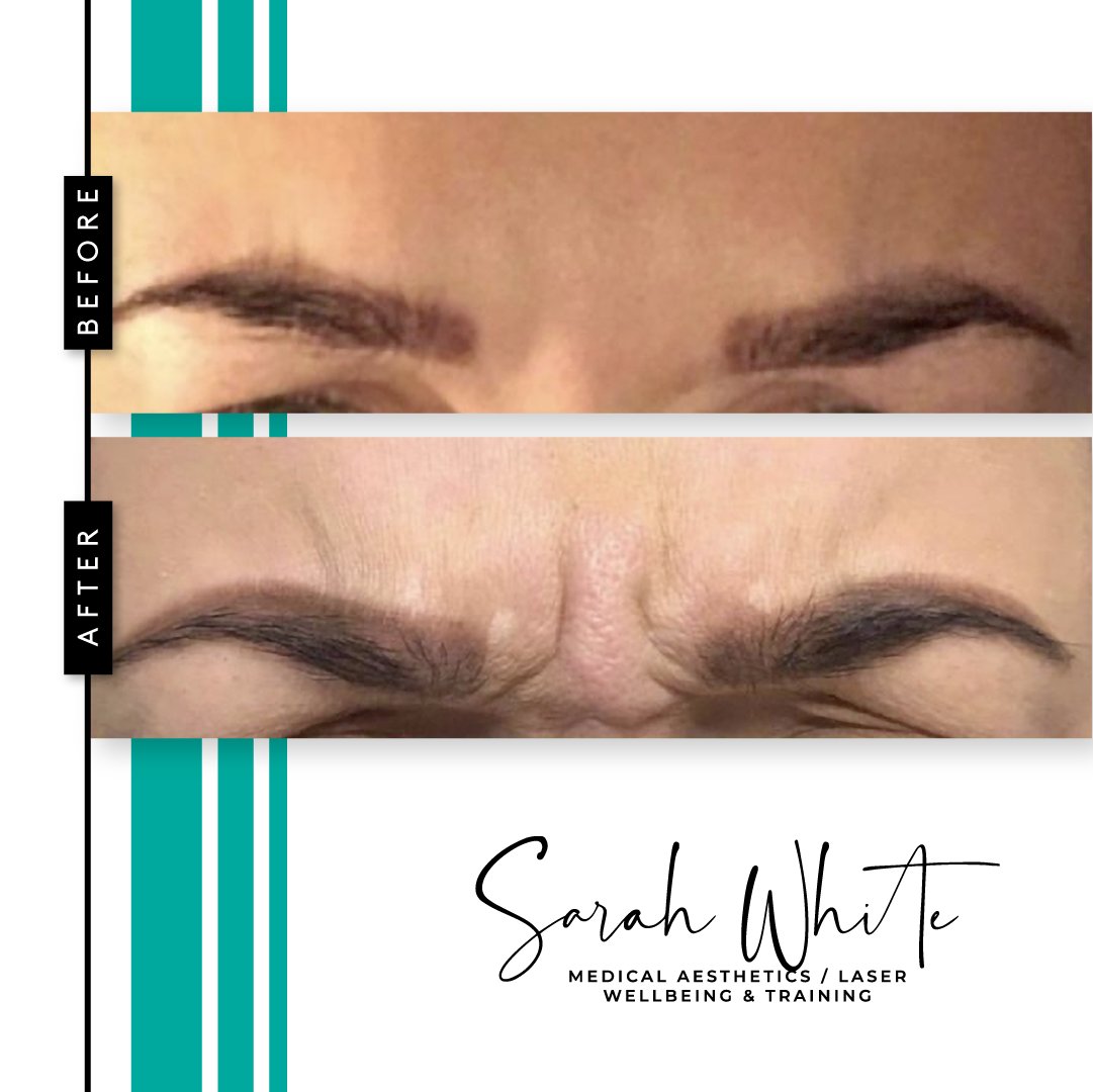 AestheticSW's tweet image. We love giving our clients their confidence back! We offer consultations for the treatment of wrinkles &amp;amp; lines! DM us for info, questions or to book in! 🖤

#sarahwhiteaesthetics #aestheticsclinic #aesthetics #facialaesthetics #facialtreatments #beforeandafter #wrinklerelaxing