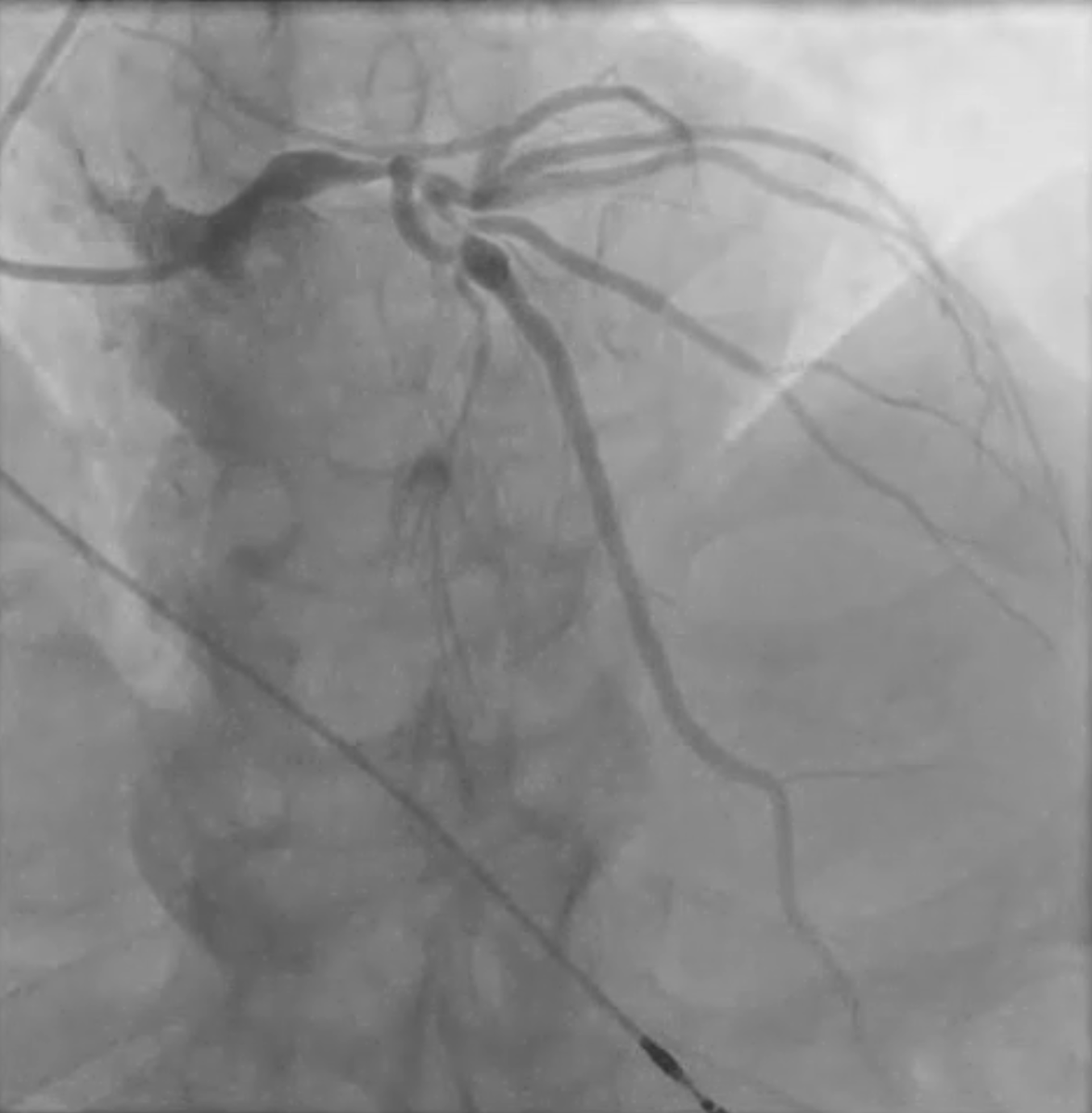 EPIC - Emory Percutaneous Intervention Course (@epicsec) on Twitter photo Difficult to wire side branch? Check out this reverse wiring by <a href="/wjn_md/">William Nicholson</a> and <a href="/PSandesara_MD/">Pratik Sandesara MD</a>. #CHIP Difficult to wire side branch? Check out this reverse wiring by <a href="/wjn_md/">William Nicholson</a> and <a href="/PSandesara_MD/">Pratik Sandesara MD</a>. #CHIP