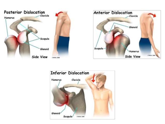 howtorelief's tweet photo. A dislocated #shoulder is when the head of the humerus is out of the shoulder joint. Symptoms include shoulder pain and instability. Complications may include a Bankart lesion.
#shoulder_dislocation #rotator_cuff
https://t.co/7VF6QfjmCJ https://t.co/T0Qz5c32Md