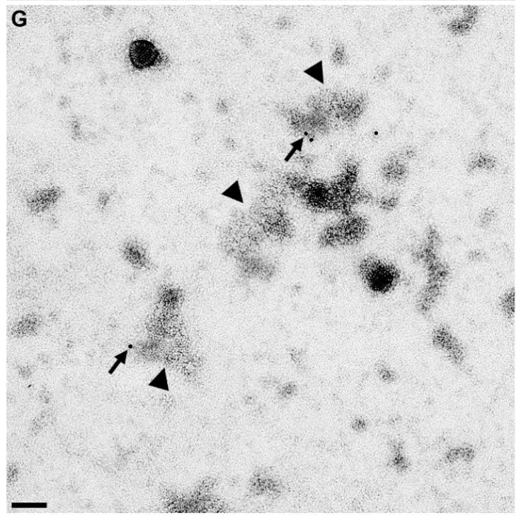 of the junk proteins in the vaccine. Then PF4 sticks to blobs of junk in the vaccine. In this image the PF4 has been marked with the small black dots (actually bits of gold). The more defined blobs are adenoviruses. As you can see the PF4 is apparently not interested in them...