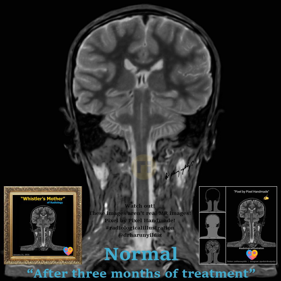 drharunyildiz's tweet image. “Waterfall Sign" / Neuro-Behçet 

doi.org/10.1016/j.radc… 

ajnr.org/content/quiz/1… 

#radiologicalillustration ✍️
Pixel by Pixel Handmade!