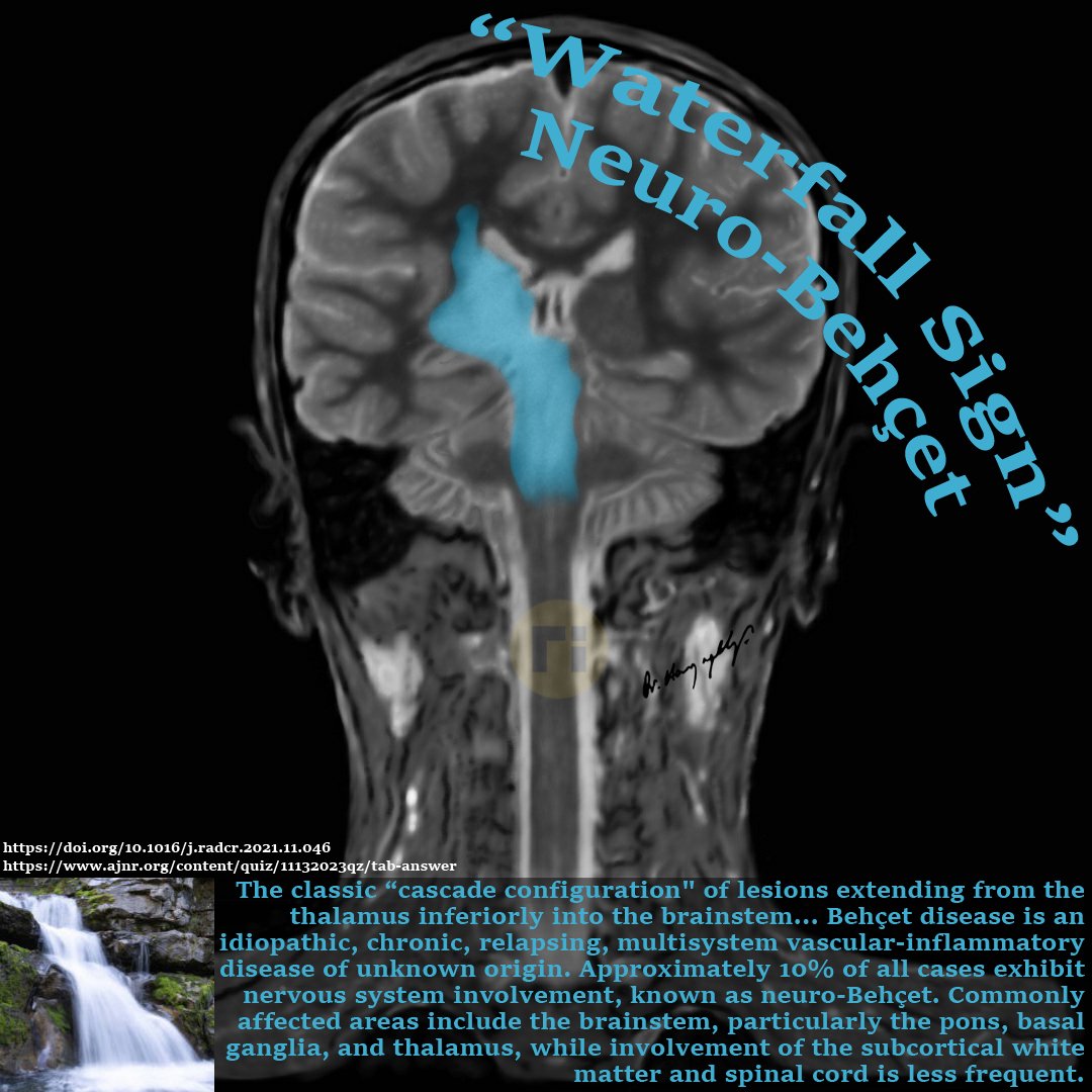 drharunyildiz's tweet image. “Waterfall Sign" / Neuro-Behçet 

doi.org/10.1016/j.radc… 

ajnr.org/content/quiz/1… 

#radiologicalillustration ✍️
Pixel by Pixel Handmade!