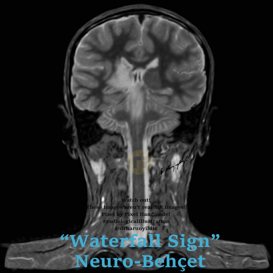 drharunyildiz's tweet image. “Waterfall Sign" / Neuro-Behçet 

doi.org/10.1016/j.radc… 

ajnr.org/content/quiz/1… 

#radiologicalillustration ✍️
Pixel by Pixel Handmade!