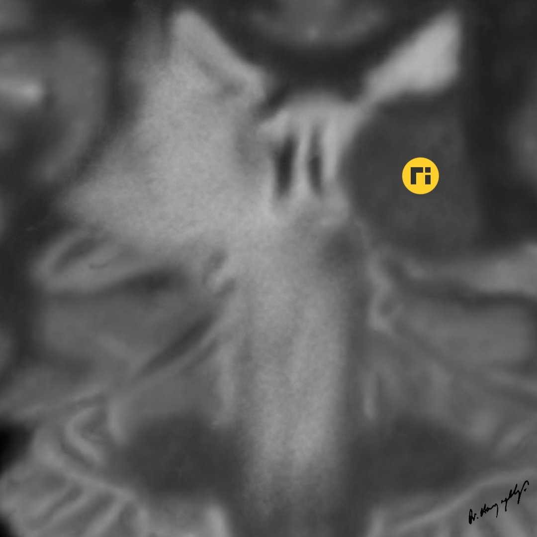 drharunyildiz's tweet image. “Waterfall Sign" / Neuro-Behçet 

doi.org/10.1016/j.radc… 

ajnr.org/content/quiz/1… 

#radiologicalillustration ✍️
Pixel by Pixel Handmade!