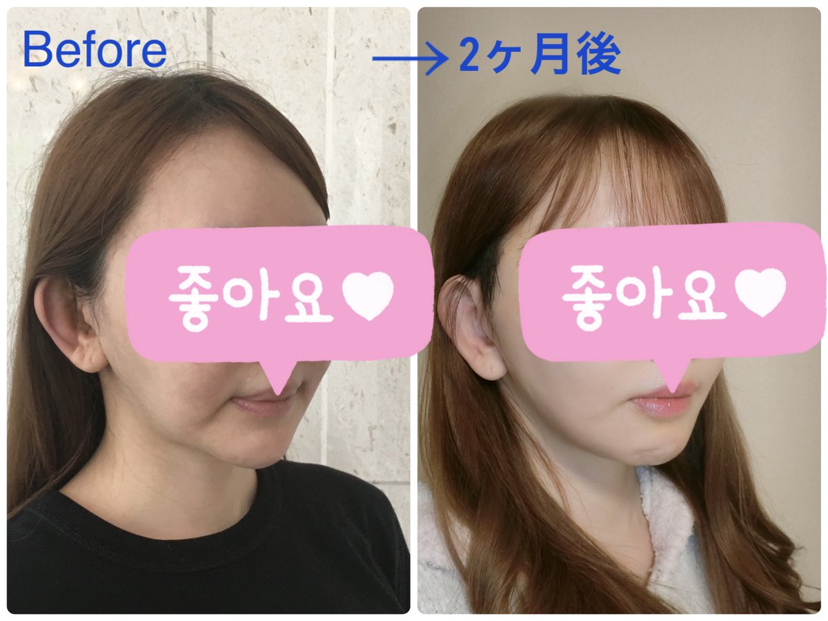 875H's tweet photo. ルフォーして小顔になったものの、
たるみがすごかったので切開リフト韓国🇰🇷でしてきたよー！

本当にやって良かった！
ダウンタイムは枕に血が流れ最初の夜は
とくにすごく痛かったし
韓国滞在中の2週間ずっとフェイスバンドで大変だったけど肌に張りもできた！

#ルフォーたるみ　#骨切り後 https://t.co/Sg20AU4jU5
