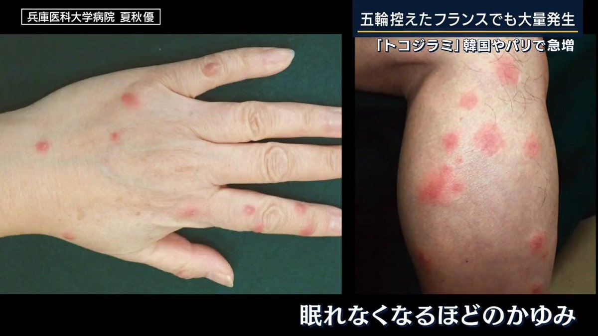 ゴールデンウィークも「トコジラミ」にご用心。刺されないための4つの対策。海外旅行先で注意、気温25度以上で活発に