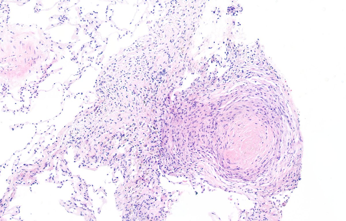 Man in his 40s. Lung #cryobiopsy showing nodular silicosis. This is a #pulmpath thread (1/11)