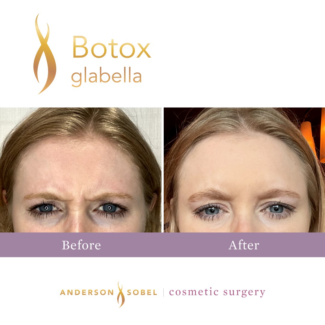 dralexsobel's tweet photo. Some Botox results for #BotoxDay!
Botox can be injected into your forehead muscles, crow's feet muscles, and glabellar muscles (aka 11's) to temporarily prevent static & dynamic wrinkles from appearing. Learn more about Botox Day deals here: https://t.co/4EMcQYjlZD https://t.co/H6KoOoJ3p5