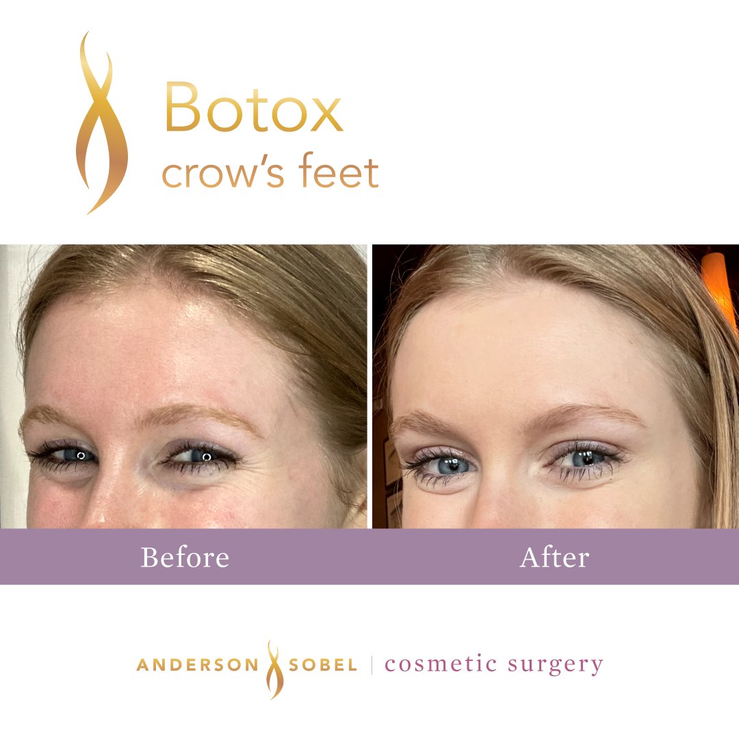 dralexsobel's tweet photo. Some Botox results for #BotoxDay!
Botox can be injected into your forehead muscles, crow's feet muscles, and glabellar muscles (aka 11's) to temporarily prevent static & dynamic wrinkles from appearing. Learn more about Botox Day deals here: https://t.co/4EMcQYjlZD https://t.co/H6KoOoJ3p5