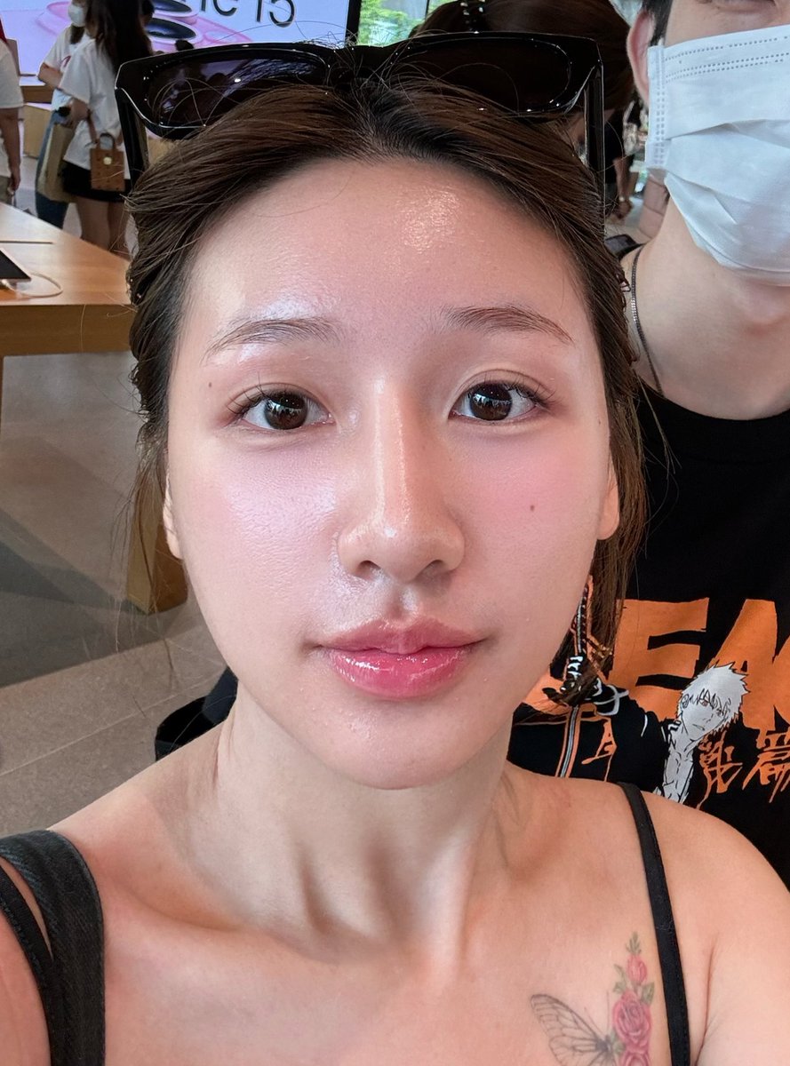 mormormorru's tweet photo. หัตถการงานผิวที่เป็นรองแค่ belotero revive นะ คือ magic peeling ของหมอเกียร์ มีหัตถการนึงที่ทำ 4 รอบแล้วในช่วง 2-3 เดือนที่ผ่านมา เพราะมันเห็นผลทันที ที่สำคัญราคาไม่แพงมากด้วย ประมาณ2พัน แล้วแบบว้าว ว้าว ว้าวทุกครั้งที่ทำ จริงๆที่ต่างประเทศมันฮิตมากเลยนะ แต่ไม่รู้ทำไมในไทยไม่ค่อยมี เคยฟังจากหมอตตว่าประเทศไทยแดดมันแรง ทำแบบบ้านเขาไม่ได้หรอก แต่หมอเกียร์คือเขาไม่ทำในระดับลอกผิว มันเป็นกรดผลไม้อ่อนๆ

ปล ในรูปคือแปะยาชาหลังจากทำ magic peeling ก็คือจิ้มเข็มต่อหวานๆ ไม่ทรมารใดใด