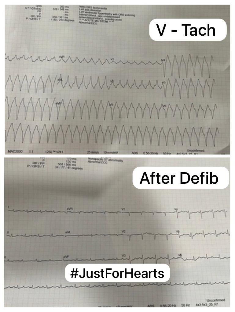 KulkarniRL's tweet photo. Timely Defibrillation by I U registrar saved the life
ICU treatment is a team approach and skilled residents / staff nurses play crucial role in patients recovery
#Arrhythmia #MedTwitter #MedX #VTach
@JustForHearts : An Initiative for HealThy Life https://t.co/KG5ZYwNyAZ