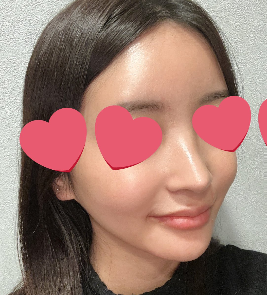 2Pfyy's tweet photo. 韓国の美容クリニックレポ✨
江南区にあるダブルM皮膚総合病院で肌管理をしてきました💓
リジュラン2cc+スキンボトックス全顔+シミ抜き注射で全てDr.手打ち！
1-2週間後から、肌がどんどん発光してきて感動！😭

肌が綺麗だとやっぱり嬉しいし、これから継続して治療できるように頑張ろ〜🥹🥹 https://t.co/BMGjGezKNS