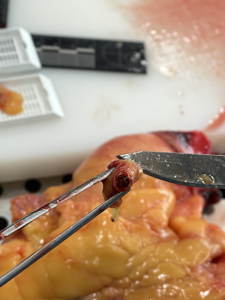 vitopuntocom's tweet photo. #Wednesday case 🫀 waiting for #histology confirmation #macropath #pathology #CVpath #autopsypath #pathTwitter #Autopsy #Forensics #coronary thrombosis https://t.co/oIpEbGlcLr