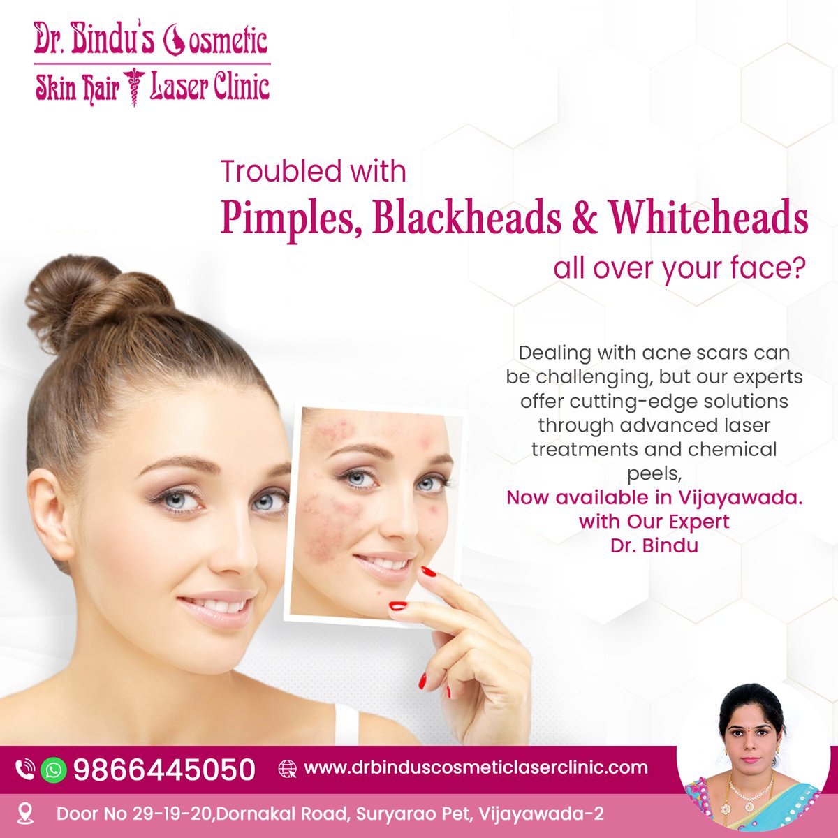 Troubled with Pimples, Blackheads & Whiteheads all over your face?

#binduclinic #laserclinic #binduclinicinvijayawada #binducosmeticlasercliinic 
#pimples #blackheads #blackheadsremover #whiteheads #whiteheadsremover #laserclinic #ageless #antiaging #antiagingskincare