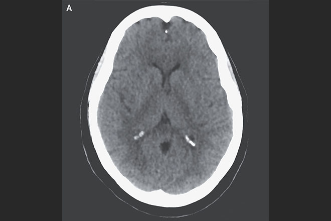 Clinical Pearls & Morning Reports: A Woman with Loss of Consciousness and Thrombocytopenia. What is the PLASMIC score? resident360.nejm.org/content-items/… #MedEd #MedTwitter