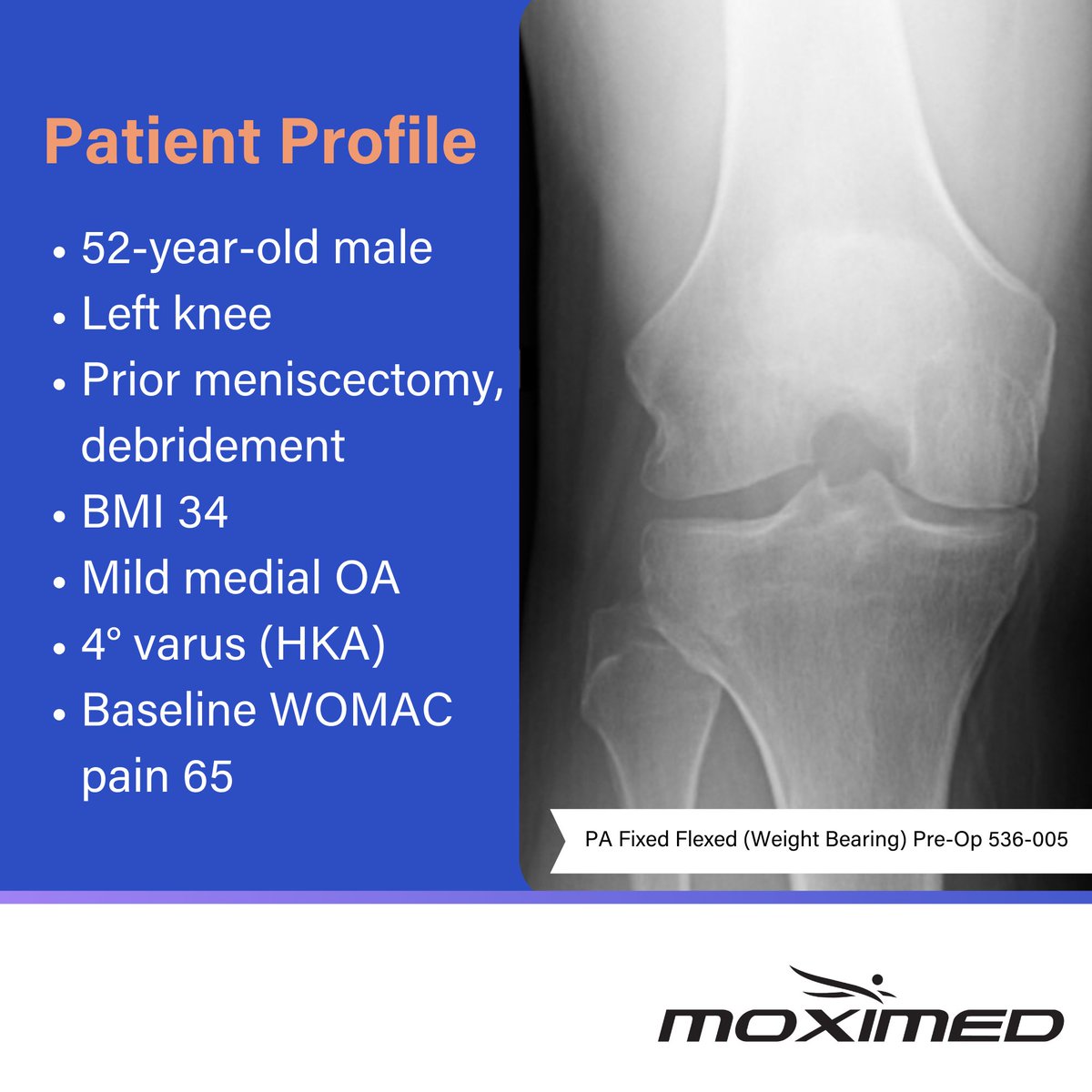 Moximed's tweet photo. Who is a candidate for the MISHA Knee System?
Patients like the one shown who suffer from medial knee osteoarthritis and are not ready for arthroplasty. 👇
See the replies for full details, including updates at their 2-year follow-up.
#MoveToMISHA #KneeOA #KneeArthritis https://t.co/cG8Z9VZKe1