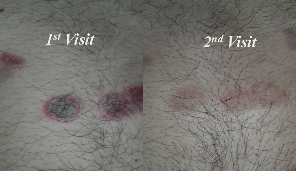 Rajnikant0257's tweet photo. **Ayurvedic Treatment in Dermatology**

Ayurvedic Dignosis:- पित्तप्रधान त्रिदोषज कुष्ठ

⏭️38yrs/M was suffering from Guttate psoriasis since 2 years,It was associated with Severe Burning sensation,Itching and reddish white scaly lession..

⏭️He has taken 3 months of  Ayurvedic medicine for 3 months and shown significant improvement..

#Ayurveda
#Psoriasis
#Dermatology