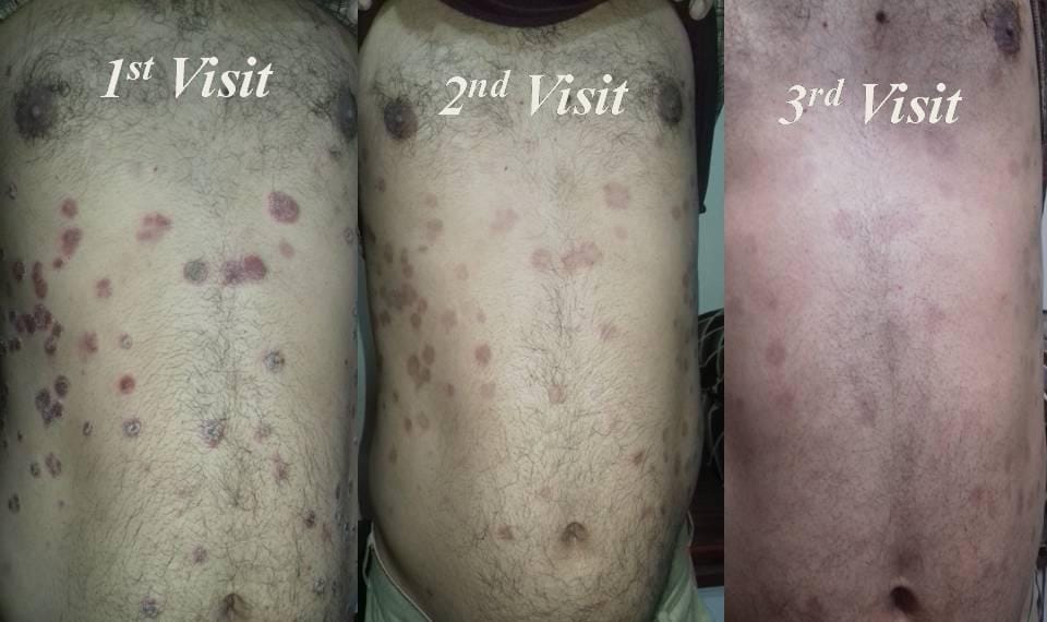 Rajnikant0257's tweet photo. **Ayurvedic Treatment in Dermatology**

Ayurvedic Dignosis:- पित्तप्रधान त्रिदोषज कुष्ठ

⏭️38yrs/M was suffering from Guttate psoriasis since 2 years,It was associated with Severe Burning sensation,Itching and reddish white scaly lession..

⏭️He has taken 3 months of  Ayurvedic medicine for 3 months and shown significant improvement..

#Ayurveda
#Psoriasis
#Dermatology